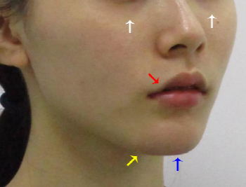 Point V Chin Tip Correction_Chin Tip Correction_Chin Tip Reduction (3).png