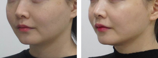 Face thread lifting Haru Lifting before and after photo (2).jpg