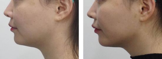 Face thread lifting Haru Lifting before and after photo (3).jpg