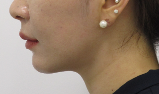 Philtrum Reduction After 1-2(2).png