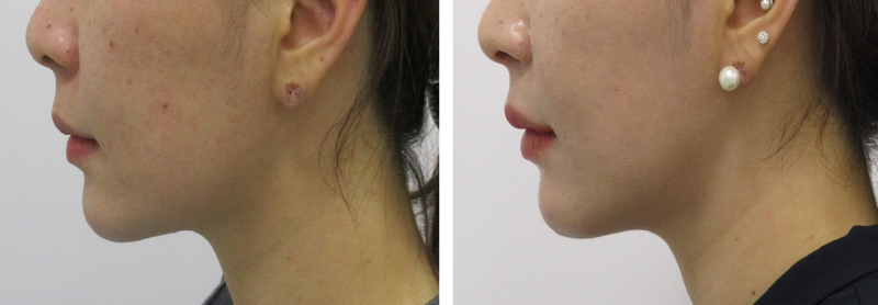 Philtrum Reduction Before and After 1-2.png