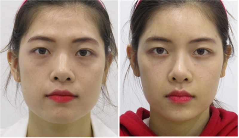Review of thread lifting, full face filler progress after Haru Lifting (1).png