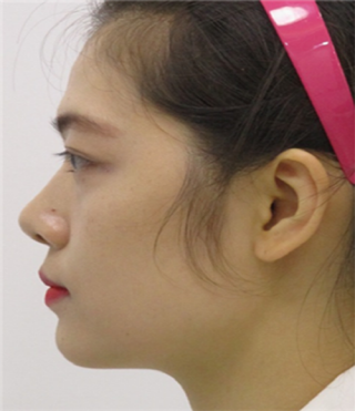 Review of thread lifting, Haru Lifting, Full Face Filler (3).png