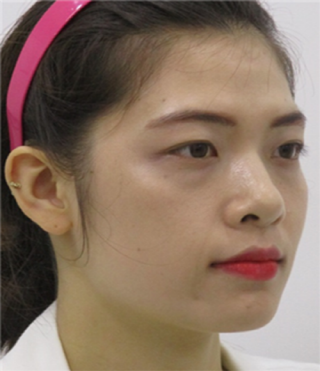 Review of thread lifting, Haru Lifting, Full Face Filler (2).png