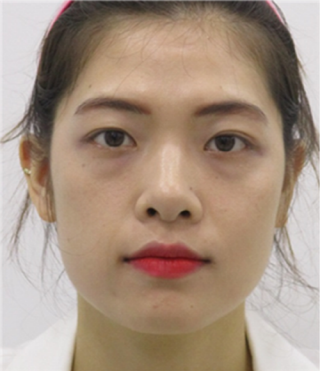 Review of thread lifting, Haru Lifting, Full Face Filler (1).png
