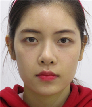 Review of thread lifting, Haru Lifting, Full Face Filler (4).png