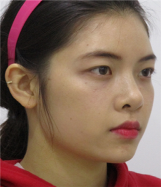 Review of thread lifting, Haru Lifting, Full Face Filler (5).png