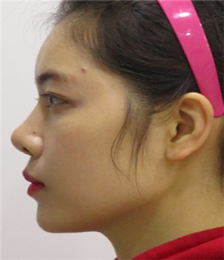 Review of thread lifting, Haru Lifting, Full Face Filler (6).png