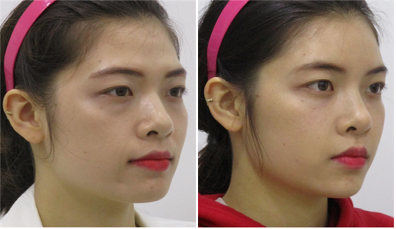 Review of thread lifting, full face filler progress after Haru Lifting (2).png