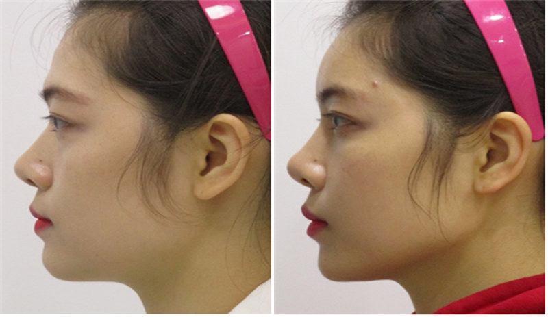 Review of thread lifting, full face filler progress after Haru Lifting (3).png