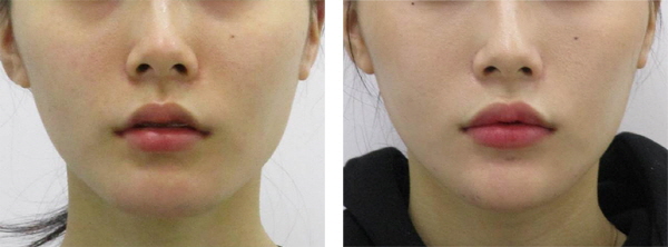 Point V Chin Tip Correction_Chin Tip Correction_Chin Tip Reduction_Before and After Photos (1).jpg