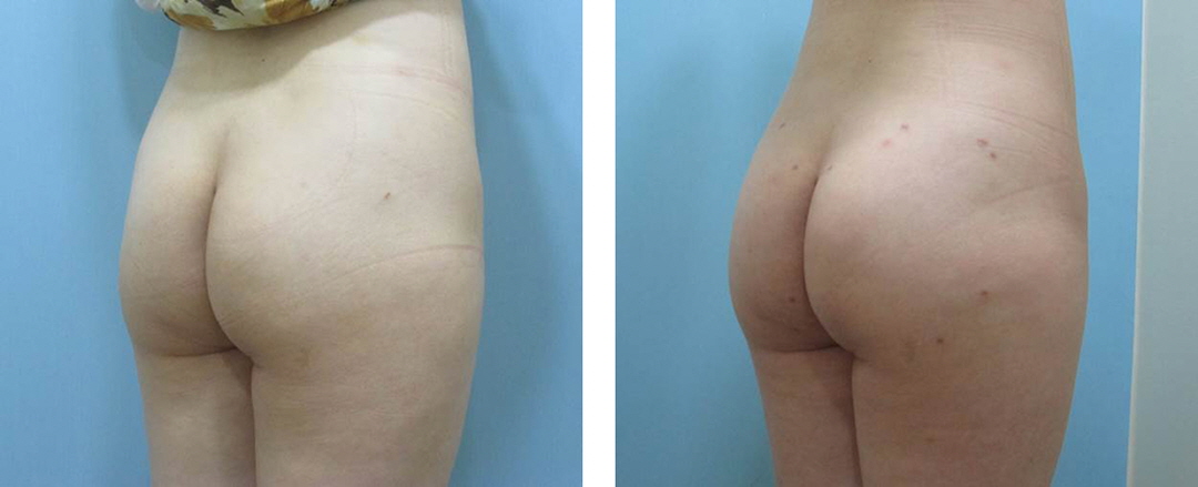 Apple Hip Lift_Before and After Hip Lift Procedure1.jpg
