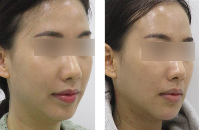 Lip Correction Lip Filler Before and After 2.png