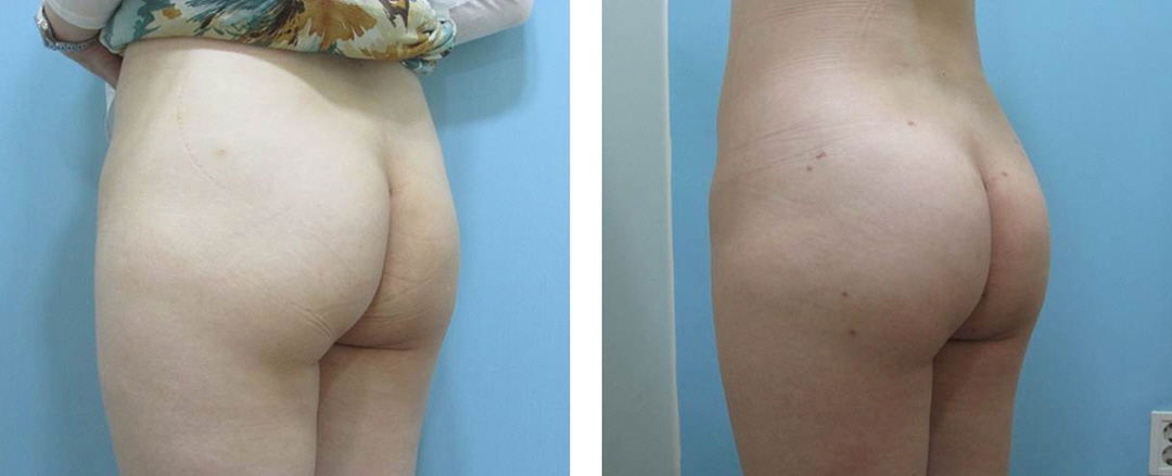 Apple Hip Lift_Before and After Hip Lift Procedure3.jpg