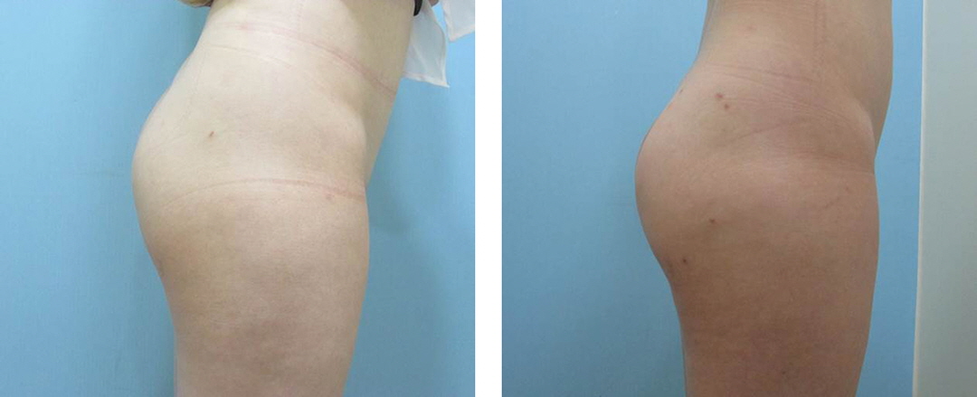 Apple Hip Lift_Before and After Hip Lift Procedure2.jpg