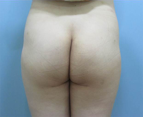Buttock lifting review_Buttock lifting procedure_Apple hip lifting3