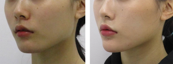 Point V Chin Tip Correction_Chin Tip Correction_Chin Tip Reduction_Before and After Photos (3).jpg
