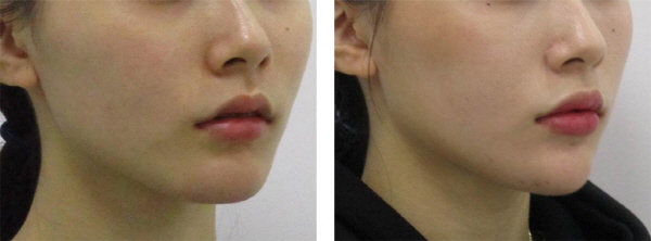 Point V Chin Tip Correction_Chin Tip Correction_Chin Tip Reduction_Before and After Photos (2).jpg