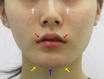 Point V Chin Tip Correction_Chin Tip Correction_Chin Tip Reduction (1).png