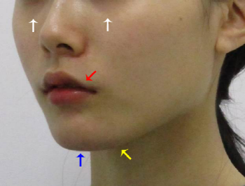 Point V Chin Tip Correction_Chin Tip Correction_Chin Tip Reduction (2).png